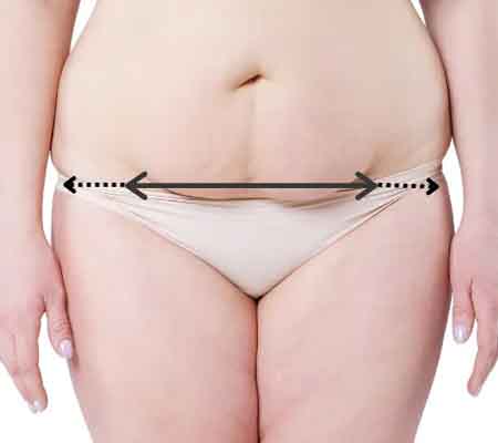 Picture of the marked abdomen before a fleur de lis procedure