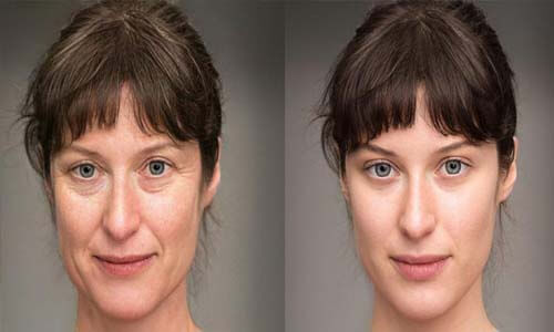 Picture of before and after facelift