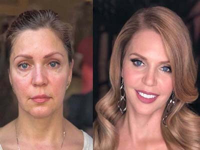 Picture of before and after facelift surgery