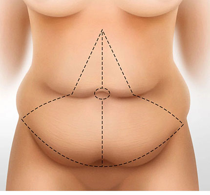 Picture of the marked abdomen before a fleur de lis procedure