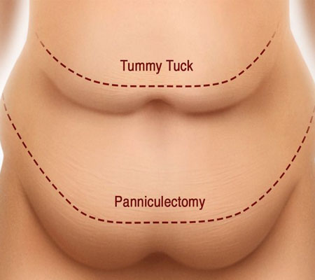 Picture of the marked abdomen before a panniculectomy procedure