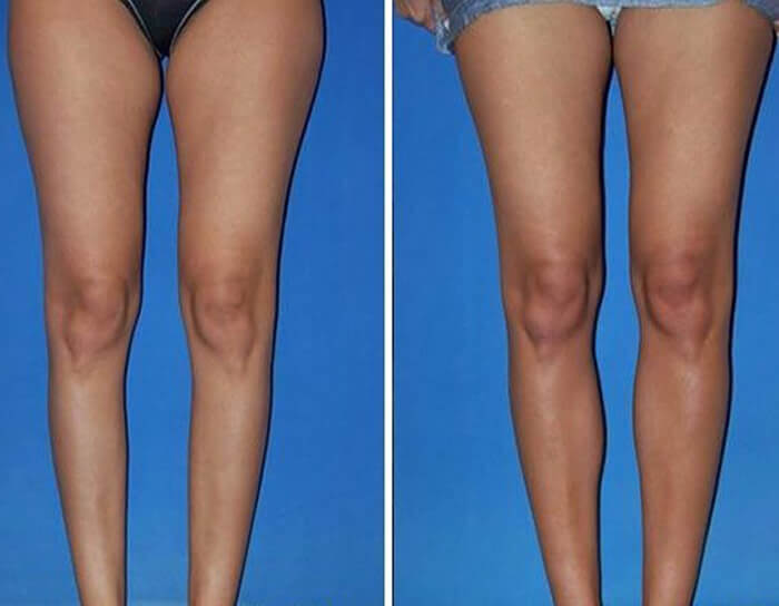 Before and After picture of a calf implants procedure showing the legs with better shape and form after the surgery.