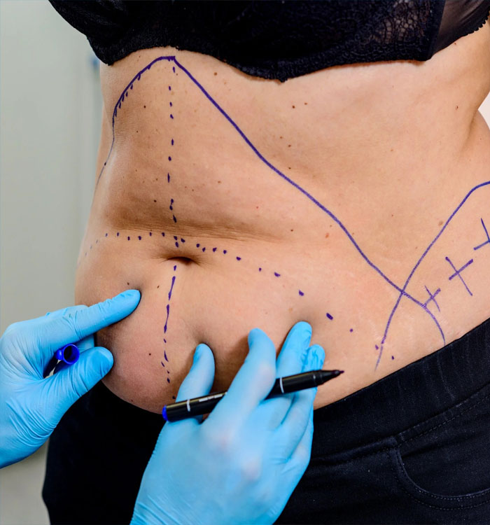 Picture of a woman showing her slim abdomen before a tummy tuck procedure in Costa Rica.