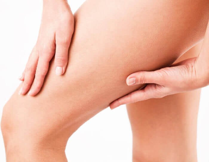 Picture of a lady showing how much trimmer her inner thigh is after having an inner thigh lift with liposuction in Costa Rica.