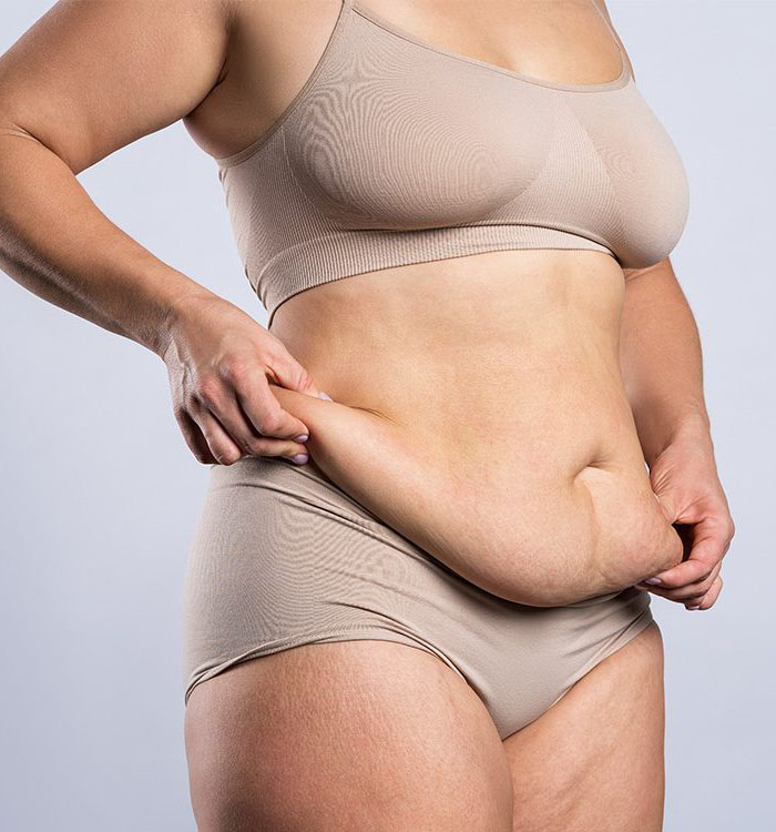 Picture of a woman showing her fat abdomen before a panniculectomy tummy tuck procedure in Costa Rica.